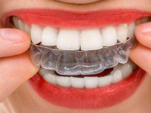 Invisalign: What NOT to Expect