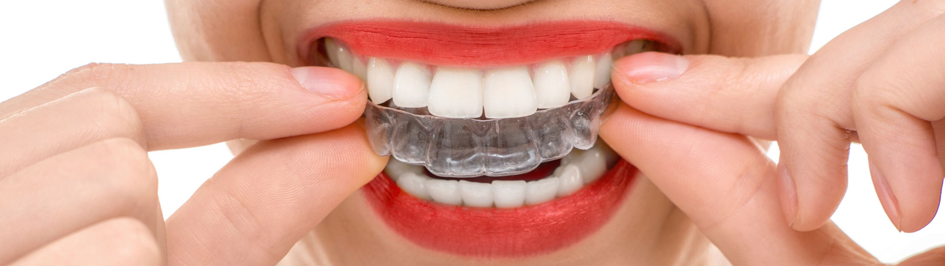 Invisalign: What NOT to Expect