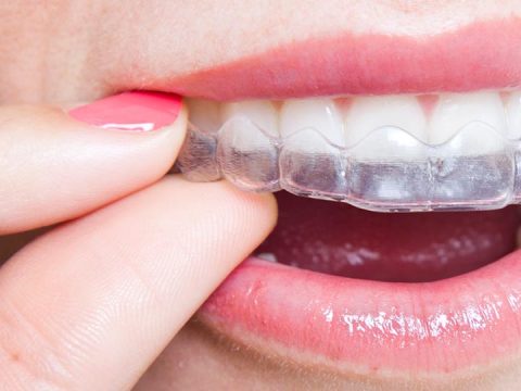 What You Won’t Get With Invisalign