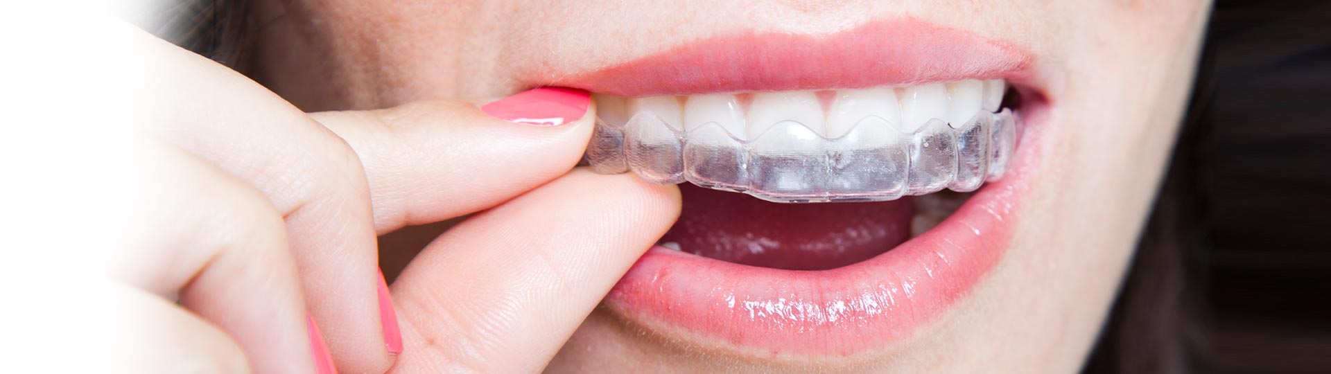 What You Won’t Get With Invisalign
