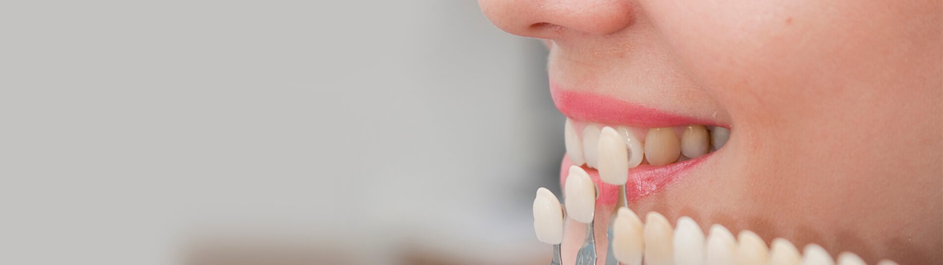 What You Need to Know about Dental Veneers