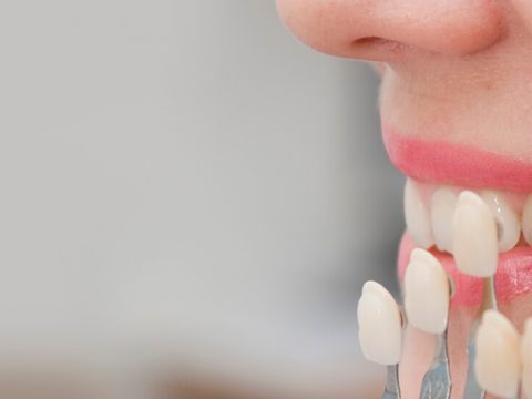 What You Need to Know about Dental Veneers