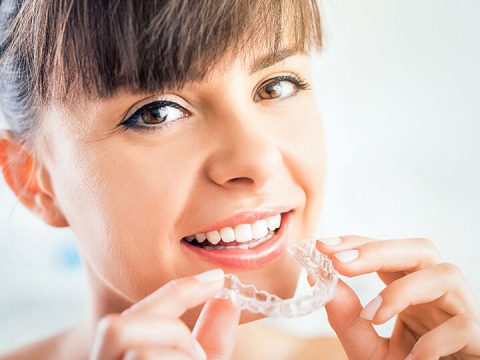 Living With Invisalign Treatment