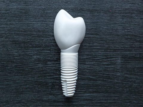 Alternatives for Traditional Dental Implants