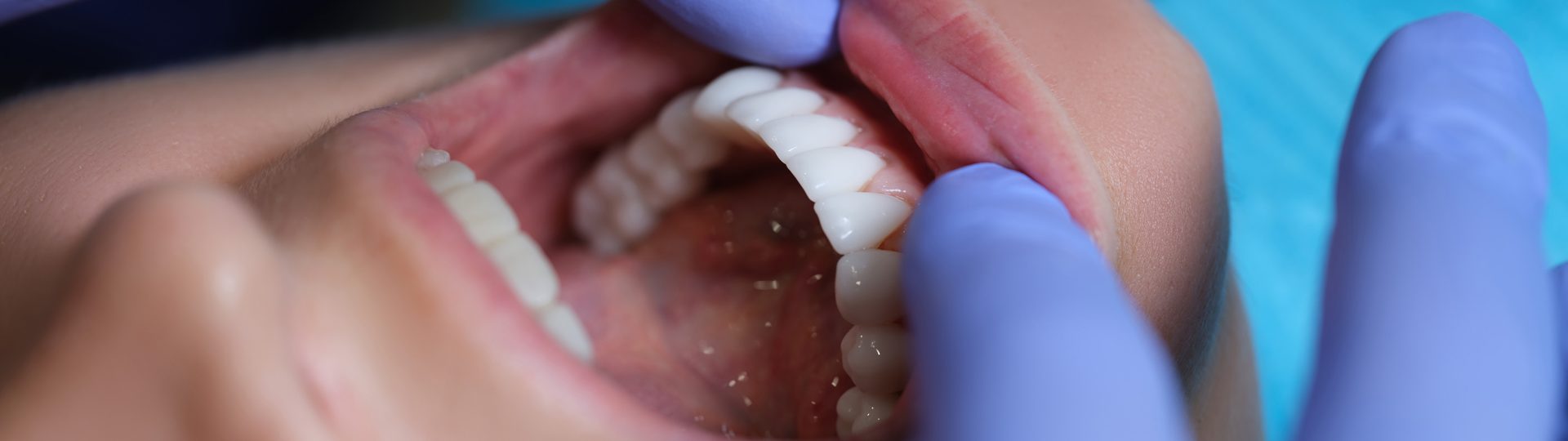 How Long Does It Take to Get Veneers Fitted?