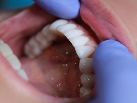 How Long Does It Take to Get Veneers Fitted?