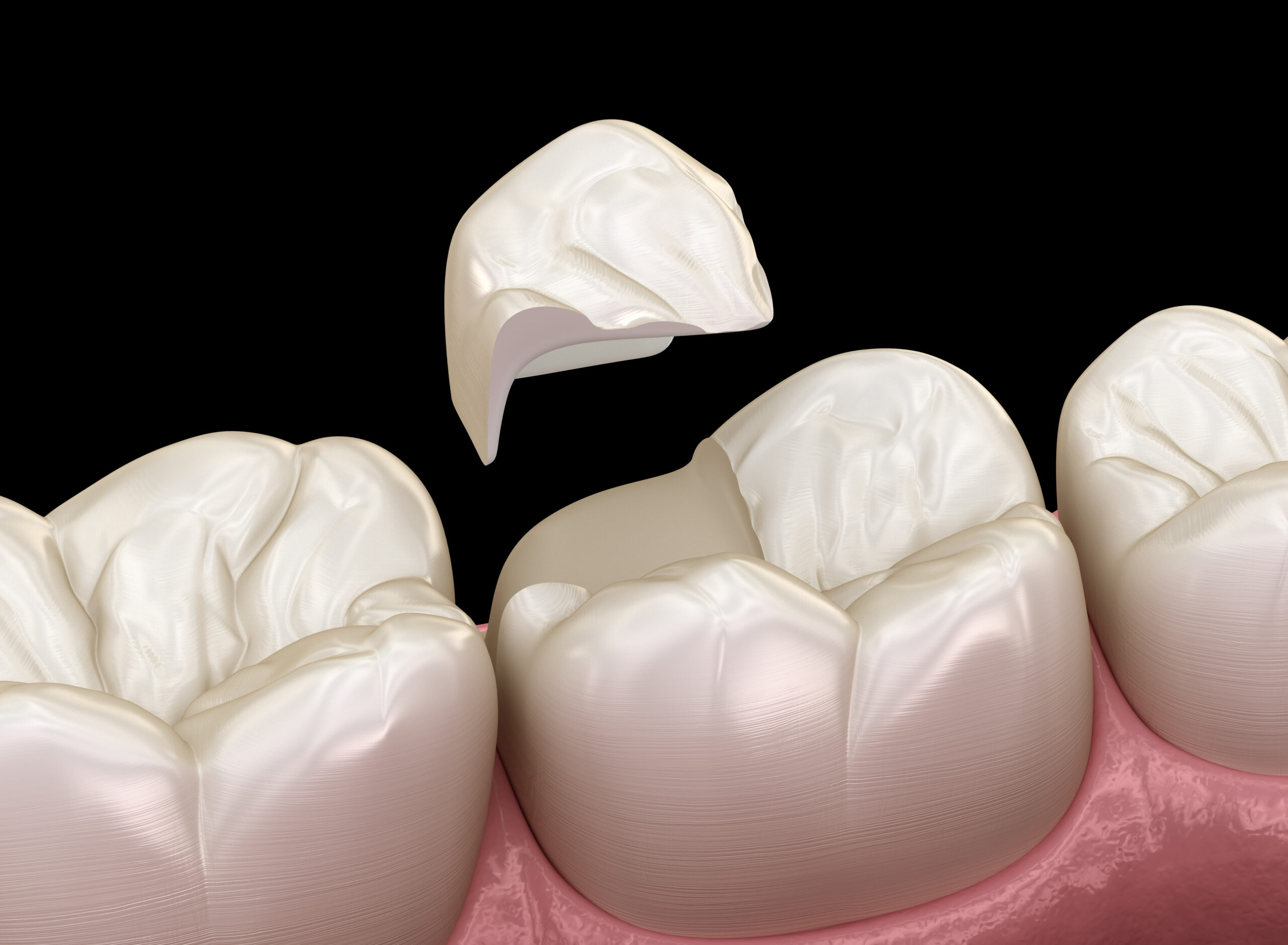 Onlay ceramic crown - QUAD Dental